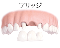 ブリッジ
