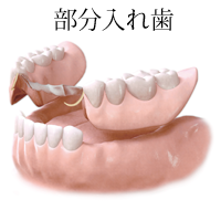 部分入れ歯